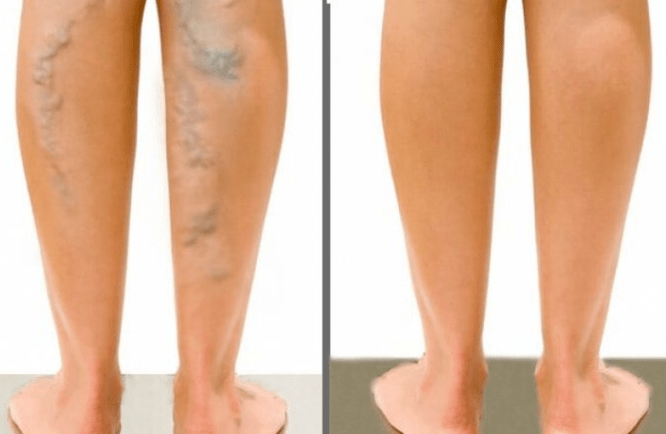 Varico veins before and after surgery