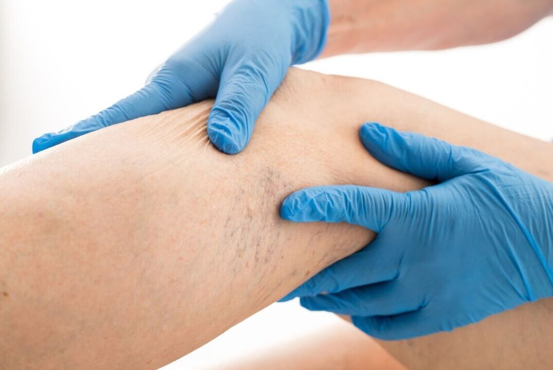 Clinical Cartin Varicoos