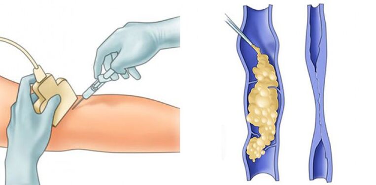 Treatment of varicos