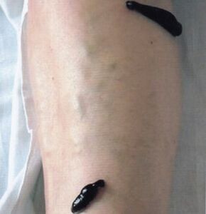 Hirudotherapy as a method of treating varicosas