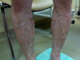 Varicose veins on legs