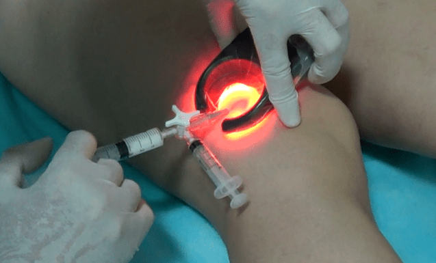 Sclerotherapy is an effective method for treating varicose veins on the legs