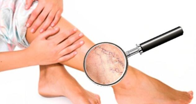 Varicose veins on legs